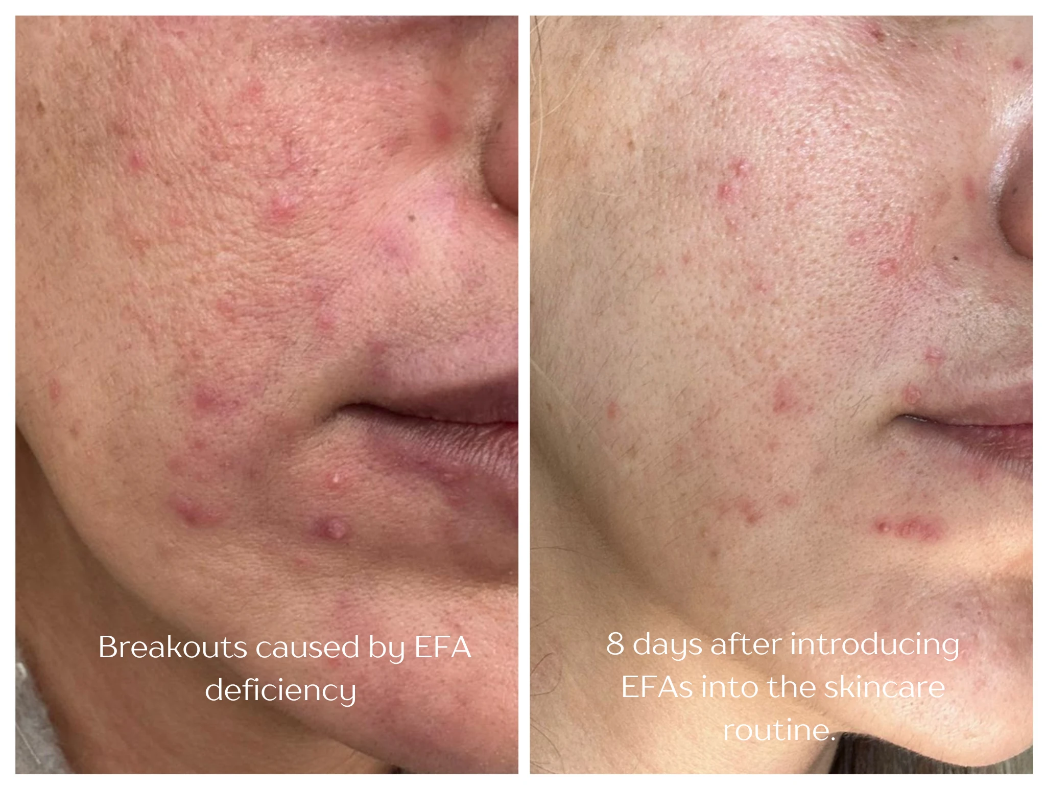 Before and after comparison showing breakouts caused by EFA deficiency on the left and improved skin after 8 days of introducing essential fatty acids into skincare routine on the right