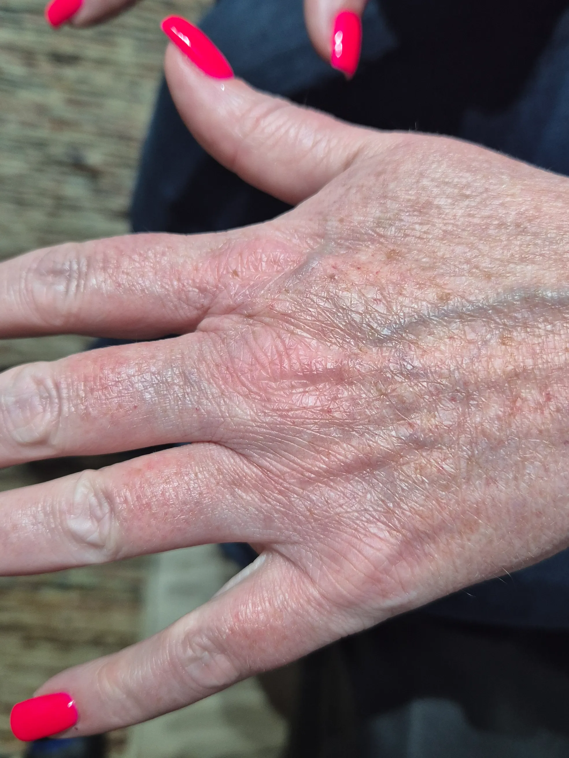 Dry cracked winter hands with eczema showing severe barrier damage and inflammation