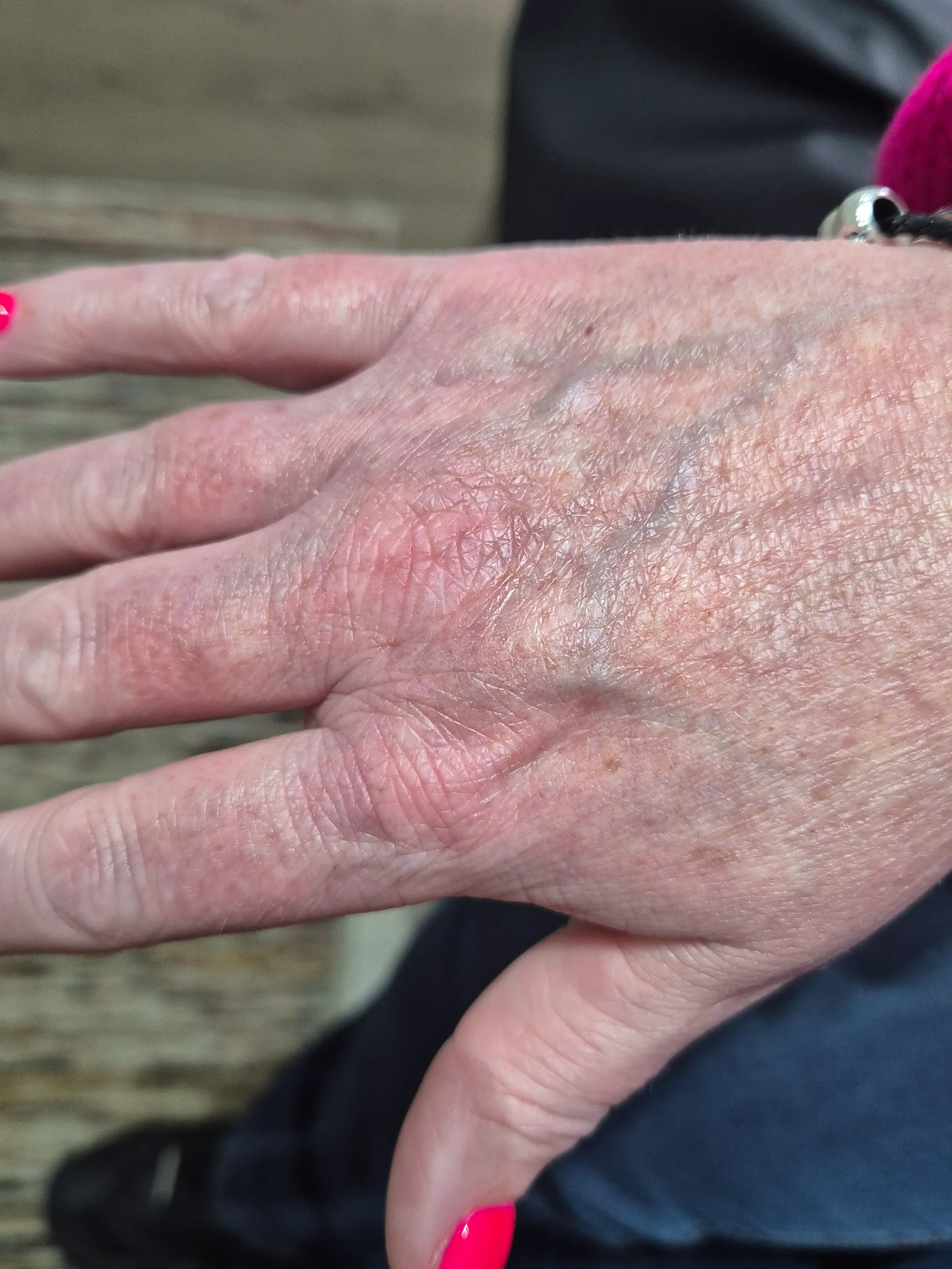 Close-up of winter hands with eczema-like dry cracked skin showing barrier damage